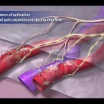 Migraine Pathophysiology - YouTube