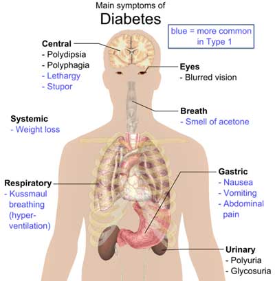 Main_symptoms_of_diabetes.jpg